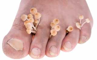 Как лечить грибок стопы и ногтей?