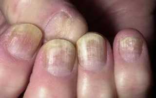 Как проявляется грибок ногтей на ногах?