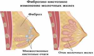 Фиброзно-кистозная мастопатия молочных желез: что это такое и ее симптомы