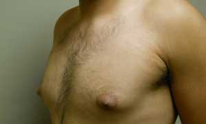 Причины возникновения гинекомастии у мужчин и подростков, способы лечения
