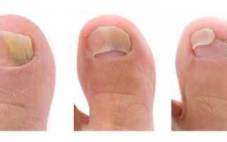 Лечение грибка ногтей на ногах при помощи уксуса