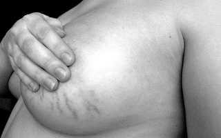 Появление вен на груди при беременности