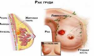 Классификация заболеваний молочной железы