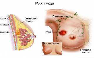Особенности лечения рака молочной железы