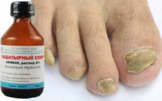 Лечение грибка ногтей нашатырным спиртом