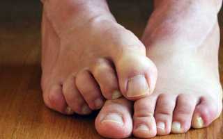 Грибок на ногах: причины, симптомы, лечение и профилактика