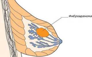 Виды фиброзной аденомы молочной железы