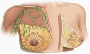 Лимфоузлы в грудной железе у женщин: строение и патология