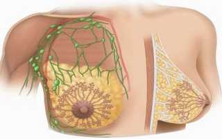 Лимфоузлы в грудной железе у женщин: строение и патология