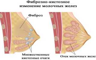 Особенности анэхогенных образований в молочной железе