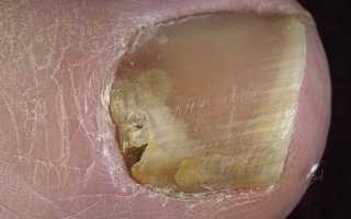 Виды грибка на ногах и способы их лечения