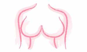 Особенности подтяжки грудных желез без имплантов