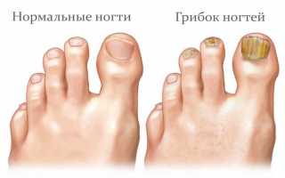 Как правильно бороться с грибком ногтей на ногах?